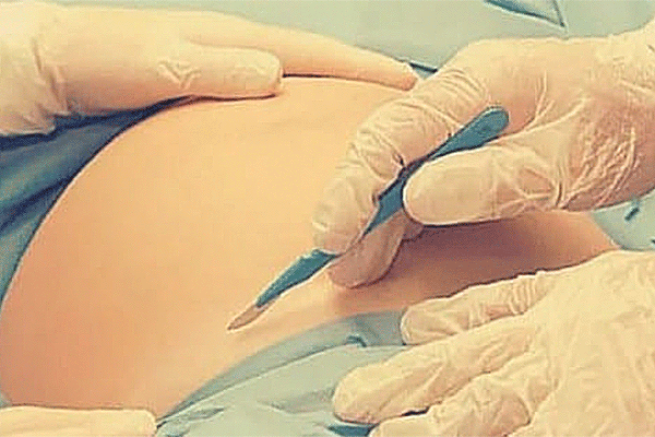 кесарево-сечение.gif